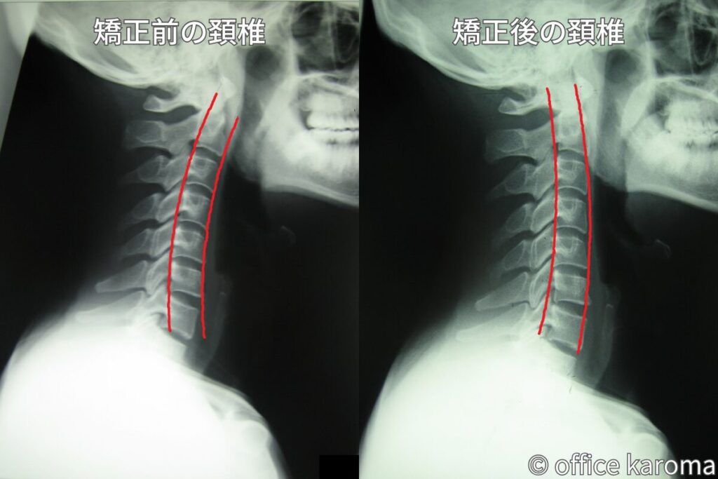 頚椎側面,プレポス