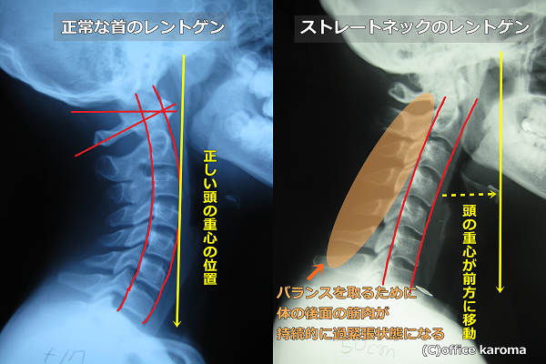 頸肩腕症候群,ストレートネック,肩こり,レントゲン