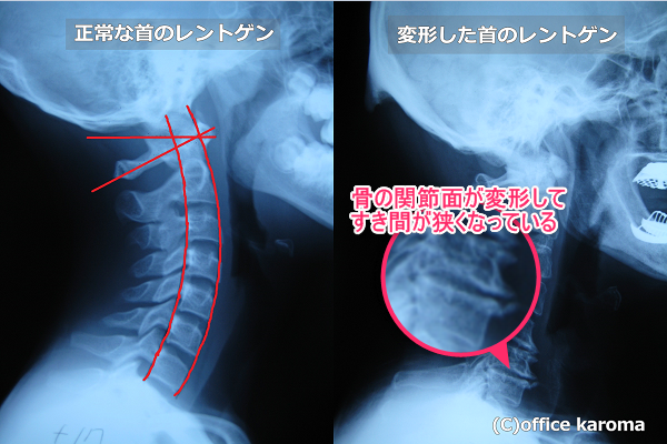 変形した首のレントゲン