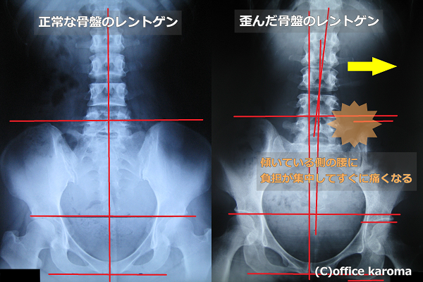 骨盤の歪みが原因の腰痛