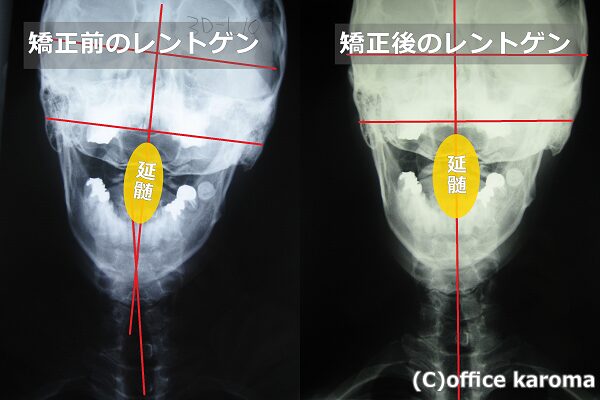 歪んだ頚椎の矯正結果と延髄の位置
