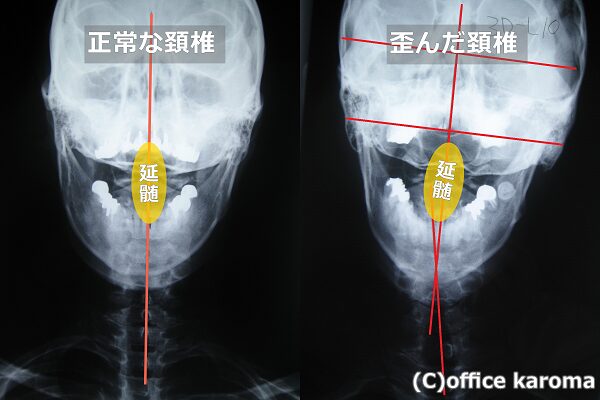 歪んだ頚椎と延髄の位置のレントゲン