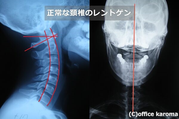 正常な頚椎のレントゲン