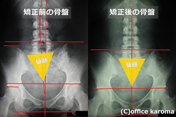 歪んだ骨盤の矯正結果と仙髄の位置