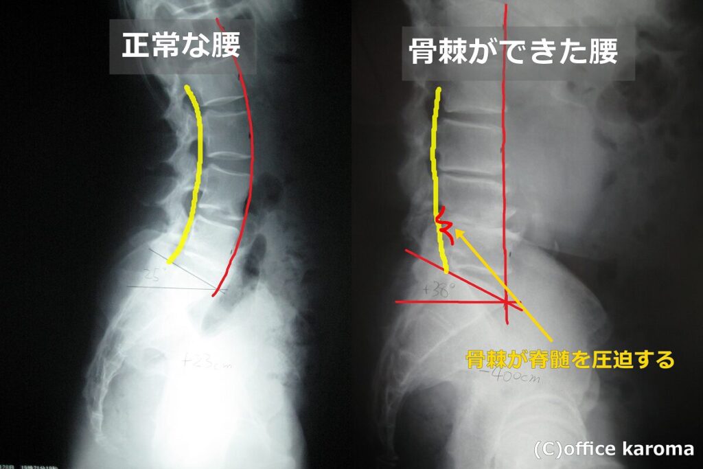 骨棘ができた脊柱管狭窄症のレントゲン