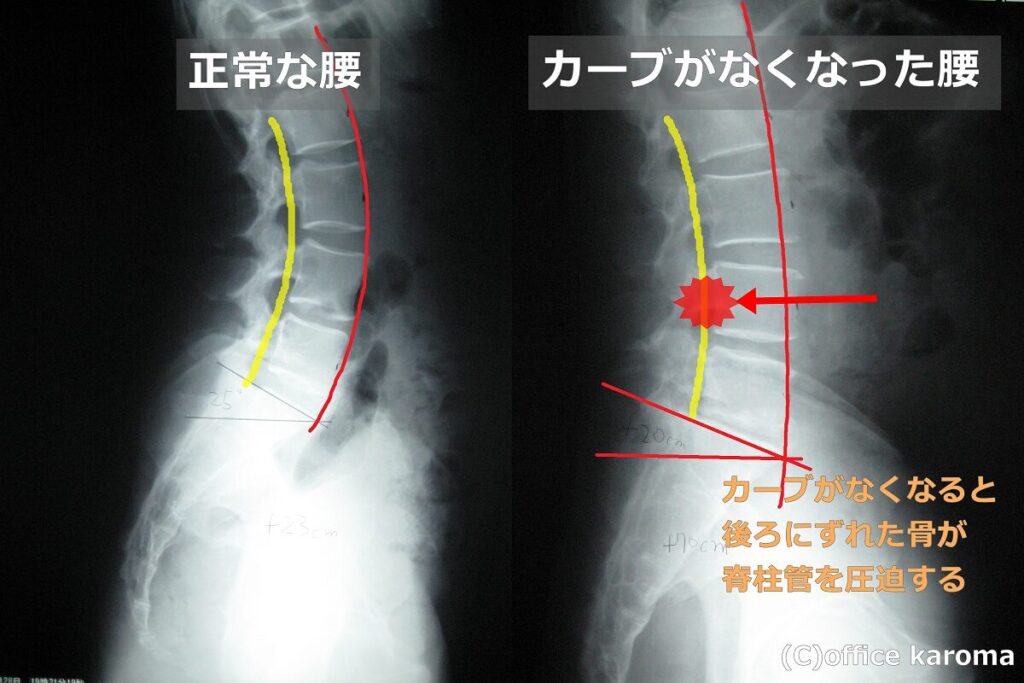 脊柱管狭窄症のレントゲン