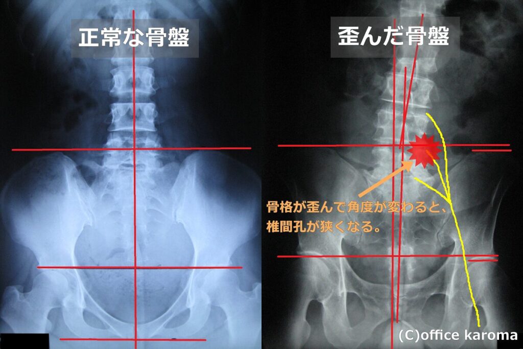 歪んだ骨盤のレントゲン、椎間孔狭窄