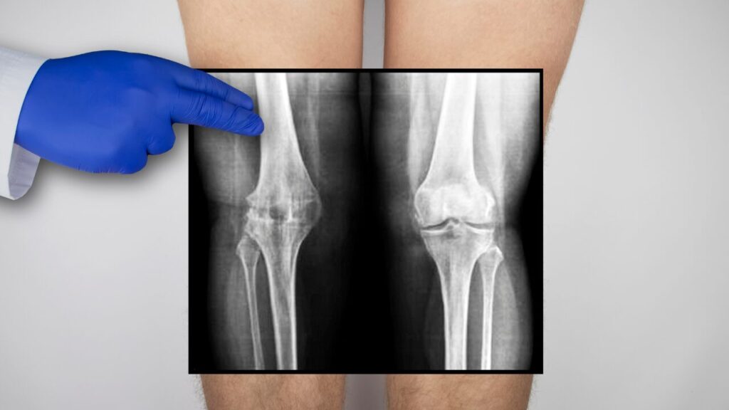 変形性膝関節症,膝のレントゲン