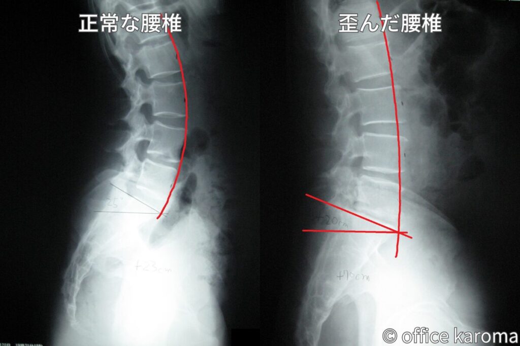 正常な腰椎とぎっくり腰になりやすい腰椎のレントゲン