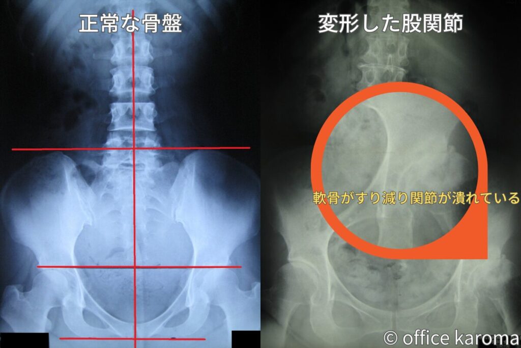 変形した股関節のレントゲン