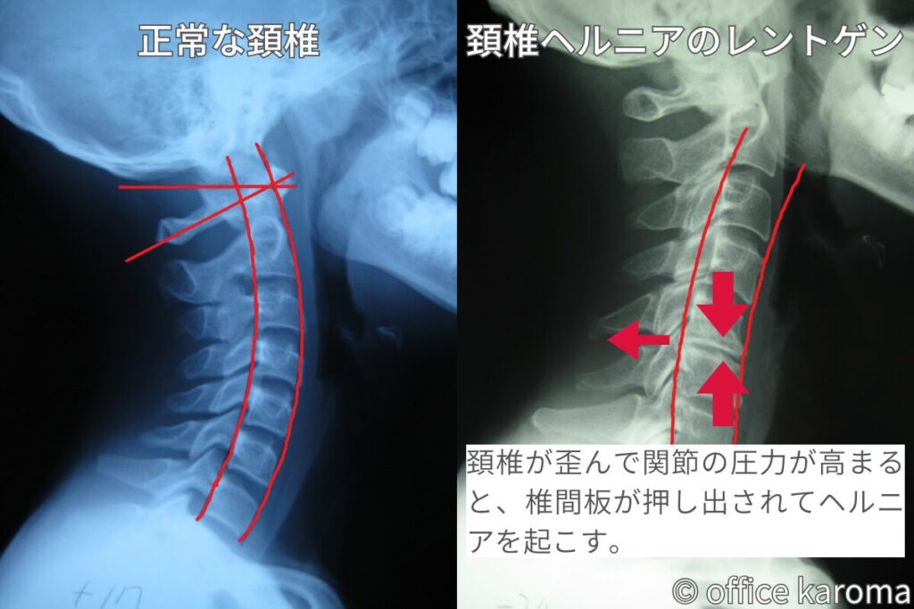 頚椎椎間板ヘルニアのレントゲン