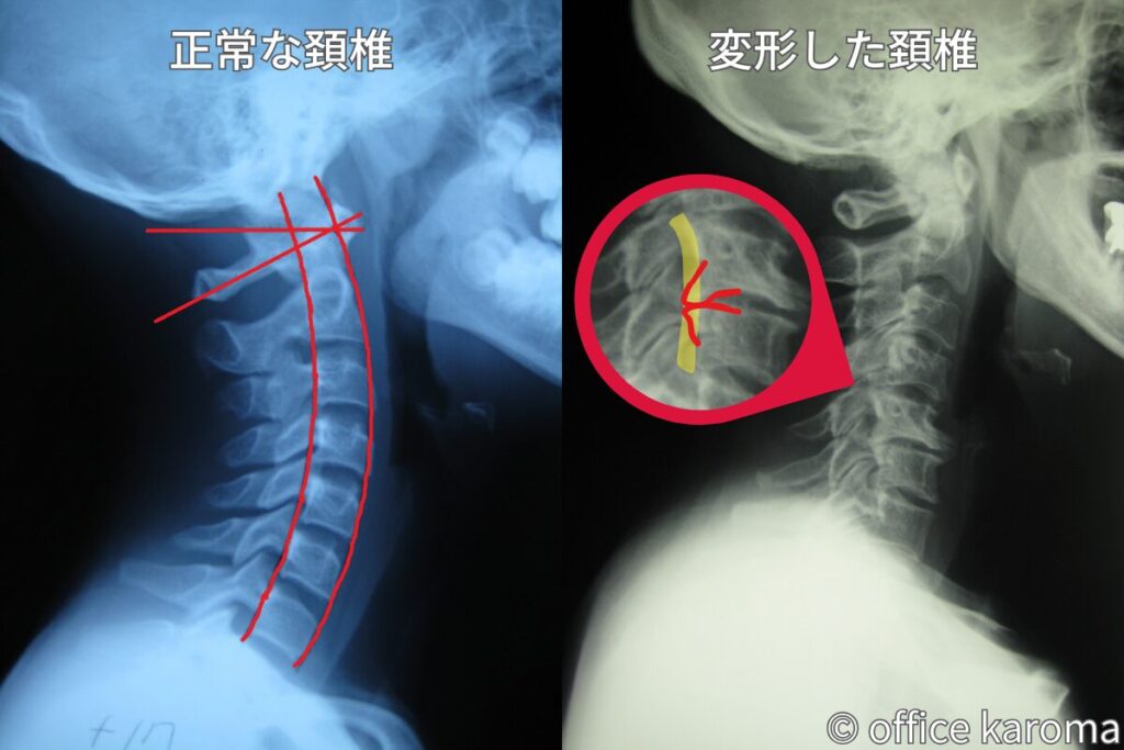 骨棘が形成された頚椎のレントゲン