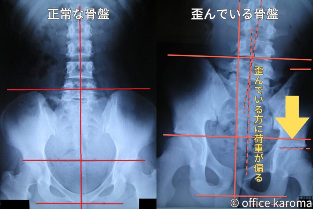 股関節に掛かる荷重,レントゲン