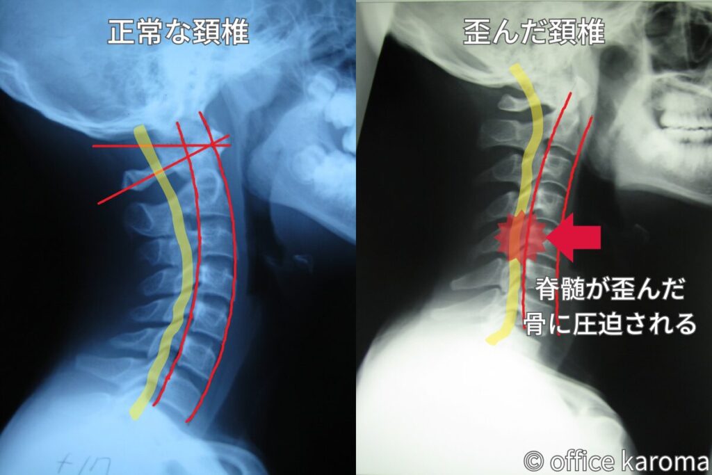 脊柱管が狭窄した頚椎のレントゲン