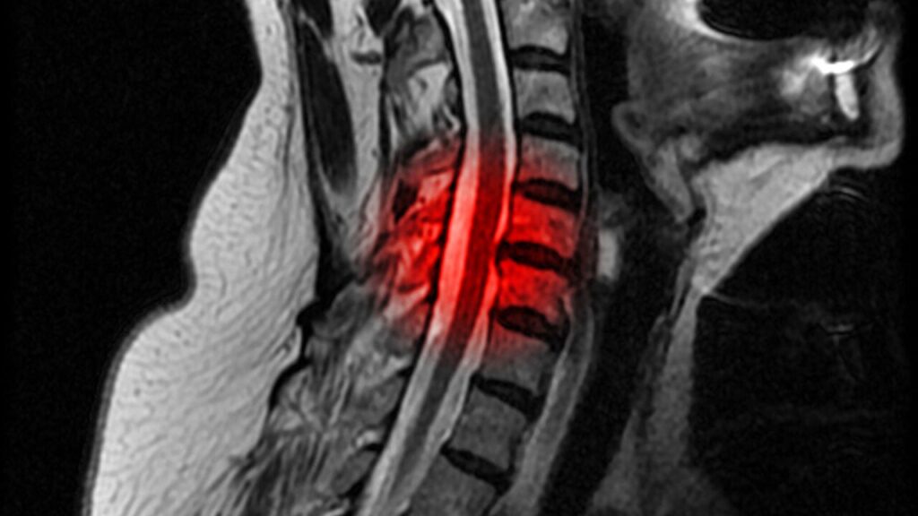 頚椎症のMRI画像
