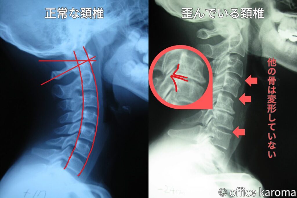 一部の骨だけ変形している頚椎のレントゲン