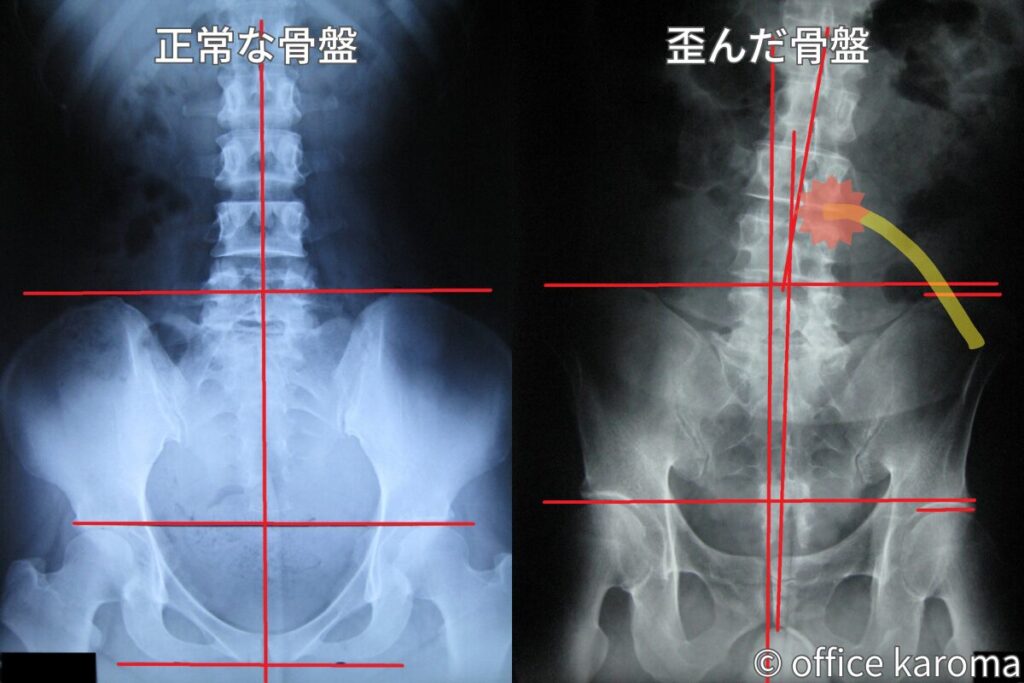 腰の椎間孔狭窄のレントゲン